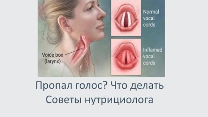 Когда теряется голос. Когда теряется голос. Голос человека сообщение. Вокальные месы. Пропавший голос.