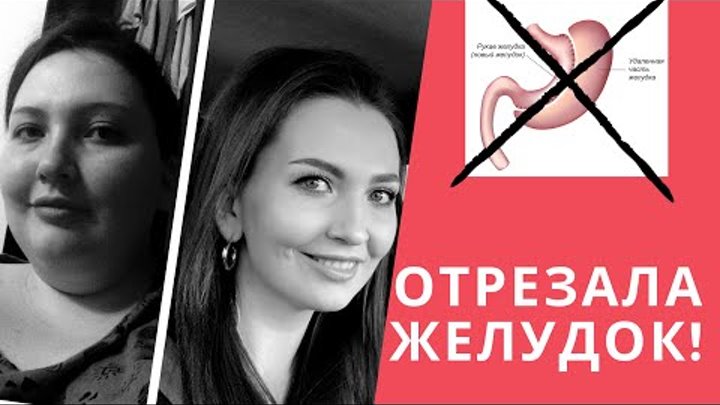 Бариатрия - Достижения и недостатки спустя 4 года после повторной операции - You