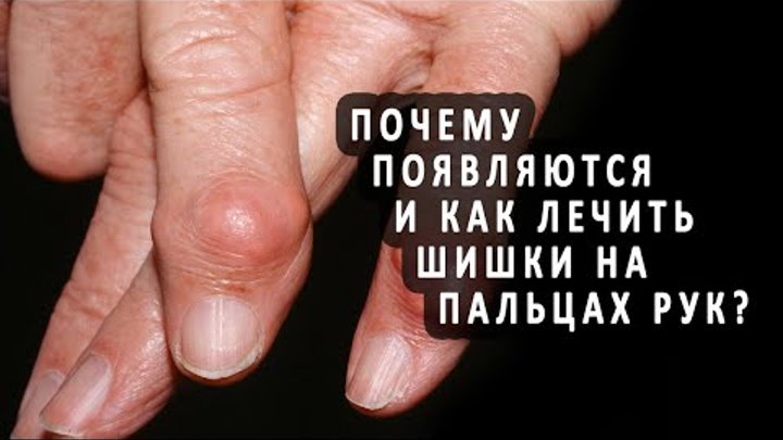 Как лечить узлы гебердена на пальцах Ирина Михайлова OK.RU