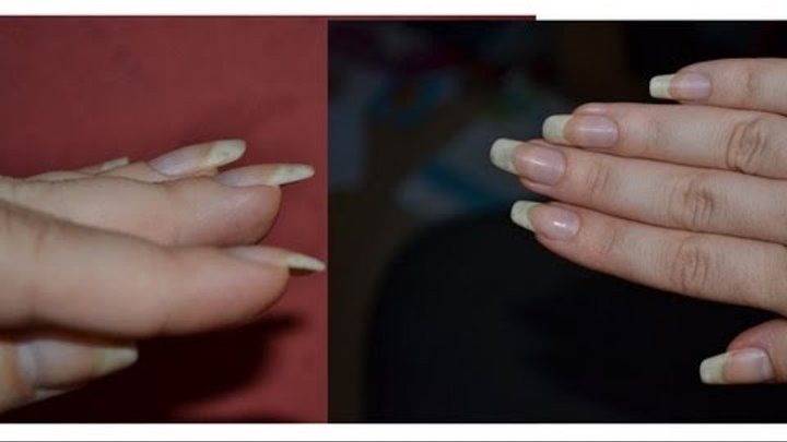 Клюющие ногти. Ногти загибаются внутрь. Ногти загибаются внутрь. Длинное ногтевое ложе. Ногти загибаются внутрь.