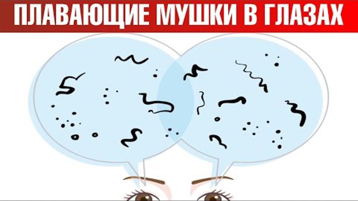 Как выглядят мушки в глазах Мушки перед глазами!  Дзен