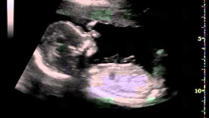 узи 18 недель беременности мальчик. почему на 18 недели. 18 недель фото. расположение ребенка в живот 18 недель. ребёнок на 18 неделе беременности.
