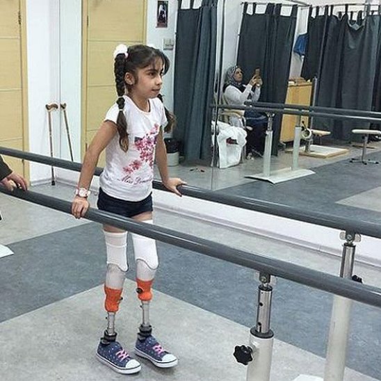 Российские врачи подарили сирийской девочке возможность ходить