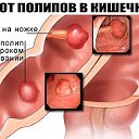 Полипы и попиломы