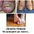 Как вылечить грибок ног и ногтей