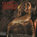 Septic Autopsy - Thousands Of Maggots Eating A Bloated Cadaver