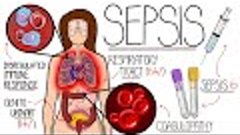 Understanding Sepsis (Sepsis Explained Clearly)