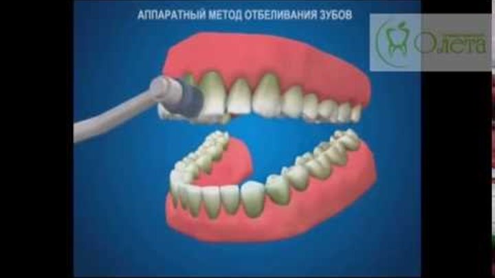 Отбеливание зубов - белоснежная улыбка в клинике ОЛЕТА