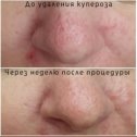 Фотография от Удаление лазером тату и татуажа