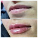 Фотография "Деликатное увеличение губ,  до и после #👌"