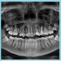 Фотография "ОПТГ❓❗️Что это❓❓❓
⠀
Мы продолжаем рассказывать вам о видах диагностики🔍, которые проводятся в нашей клинике)
⠀
Качество лечения зубов зависит от точности поставленного диагноза!👌
⠀
Наиболее часто встречающимся обследованием челюсти в стоматологии🦷, является ОПТГ!
⠀
Что же это за страшная аббревиатура ОПТГ❓❓❓
⠀
Ортопантомограмма(ОПТГ)-это панорамный рентгеновский снимок, который охватывает обе челюсти и все зубы!
⠀
Благодаря панорамному виду челюстей, врачу 👩🏼‍⚕️ намного проще определить, какое лечение пациенту подойдёт больше, как лучше его провести и не возникнут ли проблемы, а также сможет заметить любые изменения!
⠀
Использование ОПТГ изображения зубов 🦷 в различных областях стоматологии:
⠀
📍терапевтическая-для разработки плана лечения ротовой полости.
⠀
📍пародонтология-для определения степени поражения пародонта.
⠀
📍ортодонтия-для исправления патологического прикуса, ортодонт назначает полный панорамный рентген.
⠀
📍ортопедия и имплантология-для точности установки имплантов и качественного вос..."
