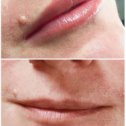 Фотография "Процедура перманентного макияжа губ заключается в введении под кожу губ красящего пигмента"