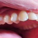 Фотография "Восстановление зуба безметалловой коронкой Emax. Прозрачность, естественность и эстетика пришеечной зоны - все преимущества перед металлокерамическими коронками видны невооруженным глазом😊
Работа :Головин С.В."