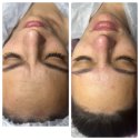 Фотография "Чистка лица-это косметологическая процедура,которую проводят для очистки дермы от кожаного сала,грязи,отмерших клеток. Косметическая чистка помогает нормализовать обменные процессы и вернуть коже здоровье."