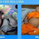 Фотография "Cure of Epidermolysis Bullosa"