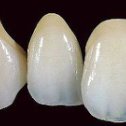 Фотография "С помощью металлокерамики можно добиться полной схожести искусственных зубов с настоящими по внешнему виду и по функции."