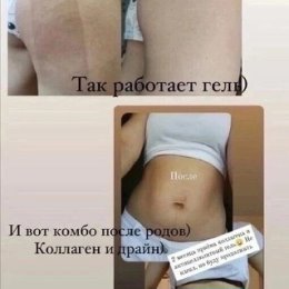 Фотография "Надоела дряблая кожа, растяжки, целлюлит?
Выход есть👍
Гель от целлюлита и растяжек💣💣💣
Вот и результат применения👍👍👍"