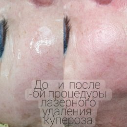 Фотография от ЛАЗЕРНАЯ ЭПИЛЯЦИ Я Абакан89617461688