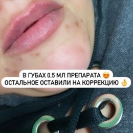 Фотография "Контурная пластика губ 🫦💉 увеличение губ #михайлов 89206300290"