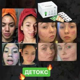 Фотография "Очищение организма 🔥
Прыщи ❌аллергия❌ дерматит ❌псориаз ❌кожный зуд ❌высыпания❓ лишний вес
🙌🙌🙌Детокс - 🌿
это самый щадящий способ очистки организма от токсинов"