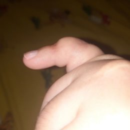 Фотография "Вот такой красивый пальчик, после трех операций и пластики!? Большое, спасибо - - Горохову Антону Владимировичу!!! "