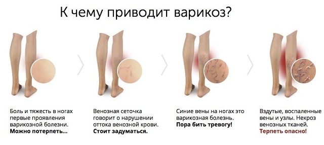 Как выглядит закупорка вен на ногах фото Как выглядит закупорка вен на ногах фото
