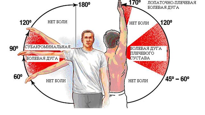 Болит левое плече у мужчины. Болит плечо при поднятии руки. Плечевой сустав болит при поднятии руки. Болит плечо при поднятии руки вверх. Дуга Дауборна.