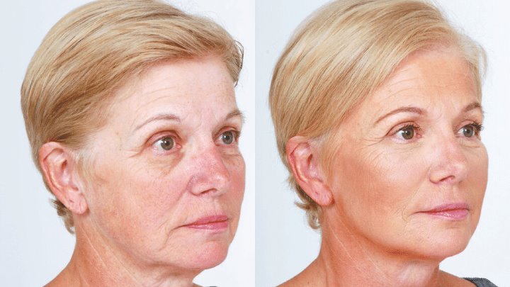 Ботокс нижней трети лица фото Ботокс нижней трети лица фото