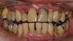 Как лечить_ пародонтоз_и_удалить_ зубной камень_в_домашних у...