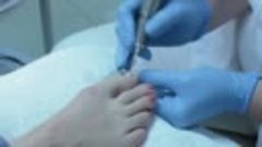 Протезирование ногтевой пластины