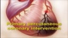Аспирационная тромбэктомия при инфаркте миокарда