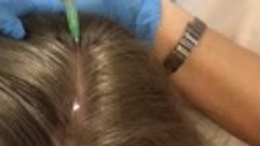 #Мезотерапия волосистой части головы, для укрепления и питан...