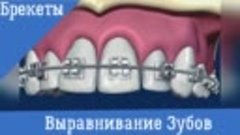 Ортодонтия. Брекеты.  Выравнивание зубов