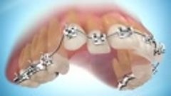 Лечение с удалением постоянных зубов