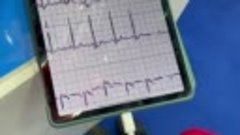 Запись ЭКГ с помощью кардиофлешки