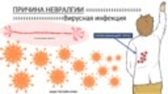 Причиной невралгии может быть вирусная инфекция #невралгия #...