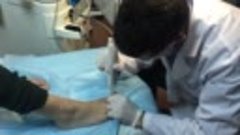 Лазерное лечение онихомикоза аппаратом Fotona. Санация ногте...