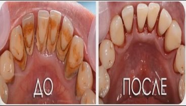 РЕЦЕПТ ОТБЕЛИВАНИЯ И ЛЕЧЕНИЯ ЗУБОВ ДОМА