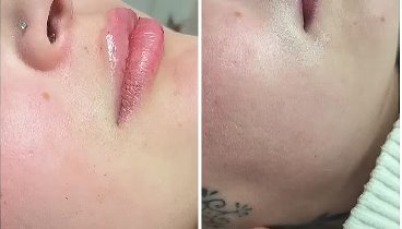 Lippen Volumenaufbau mit Hyaluronsäure 😍 Russian Lips Technik 