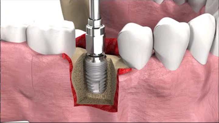 Имплантация зубов: виды, техника операции и цены