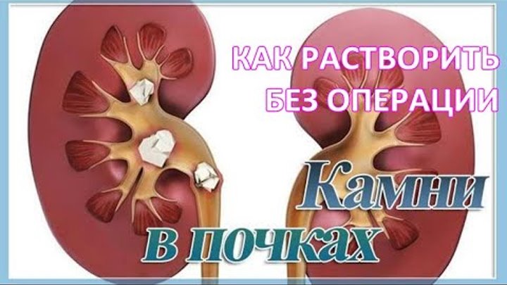 Вода от камней в почках. Препараты растворяющие камни в почках. Препарат для дробления камней в почках. Растворимость почечных камней. Растворитель камней в почках.