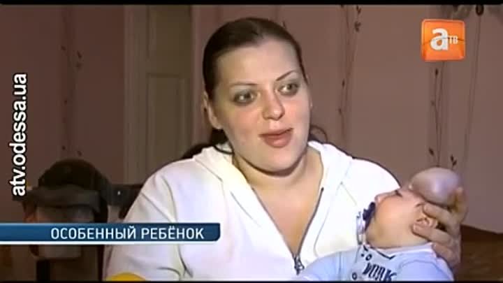 В Одессе живёт единственный в мире малыш без черепа