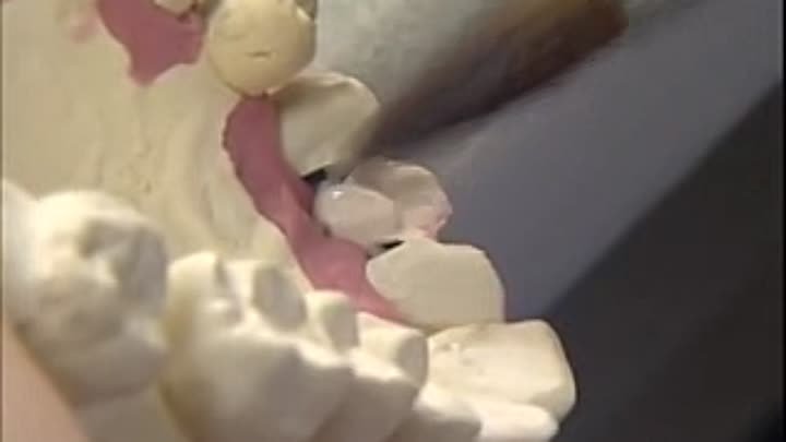 frontal tooth (metallokermica)