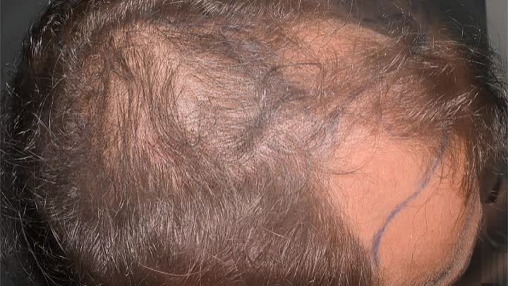 Результат пересадки волос. Доктор Айхан Чолак