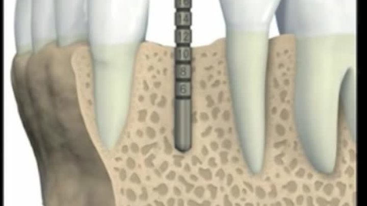 Имплантация зуба-1 этап