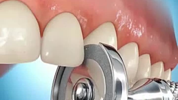 Сепарация зубов на верхней челюсти