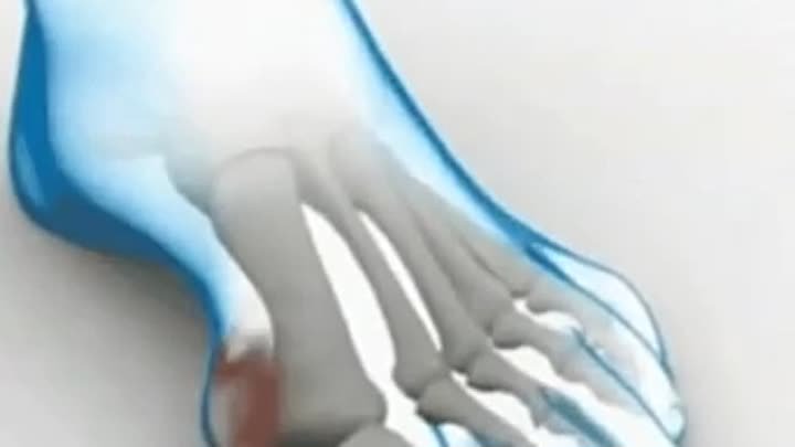 Оперативное лечение Hallux Valgus-522187049514