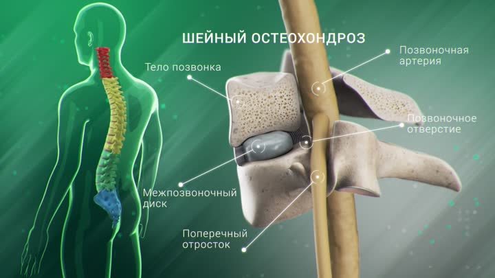 Что такое шейный остеохондроз