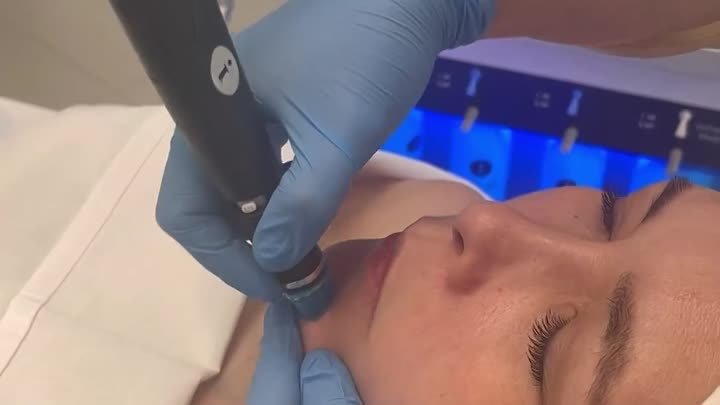 Аппаратный уход для лица - Hydrafacial