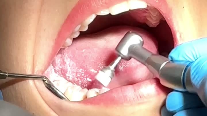 Как мы делаем профессиональную чистку зубов. Смотрим!